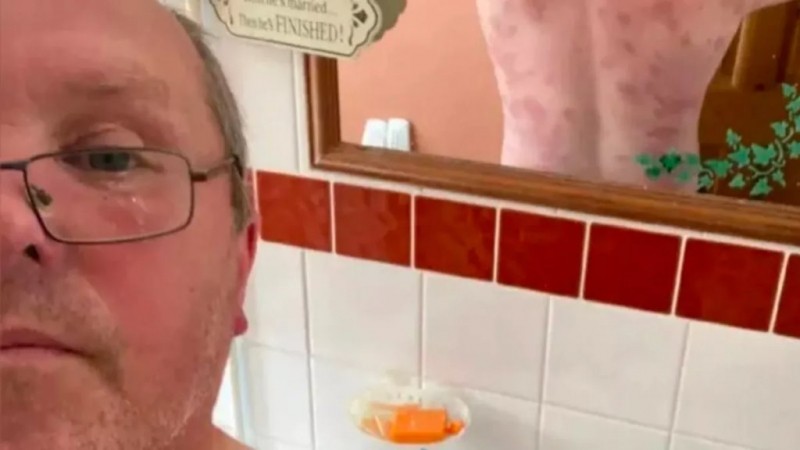 Мужчина выжил после 240 укусов ос